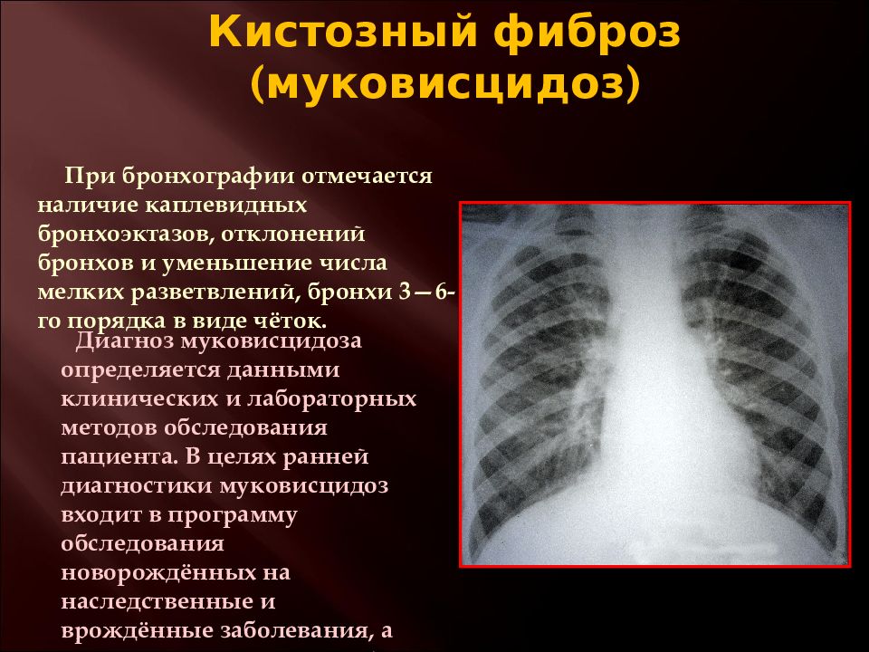 Последствия фиброза. Муковисцидоз бронхограмма. Кистозный фиброз легких.