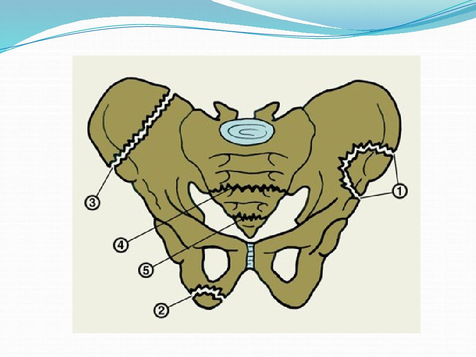 Перелом костей таза рисунок