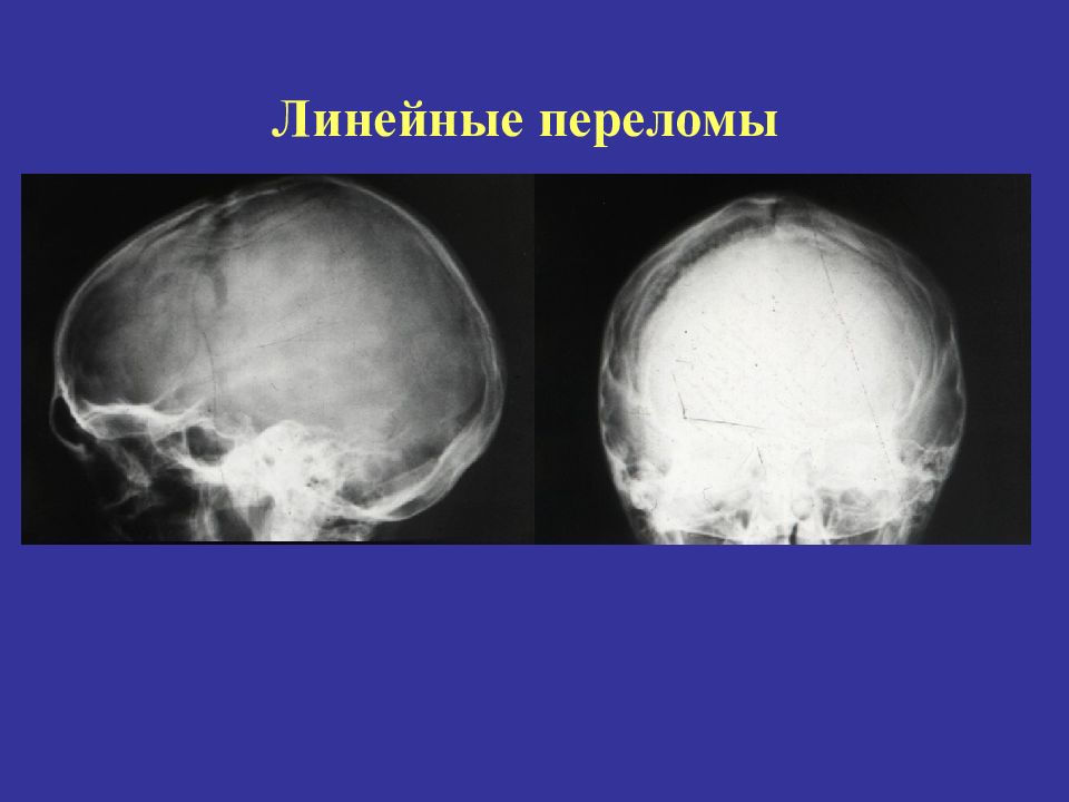 Перелом теменной кости у грудного. Перелом теменной кости черепа рентген. Импрессионный перелом черепа. Перелом лобной части черепа. Линейный перелом теменной кости.