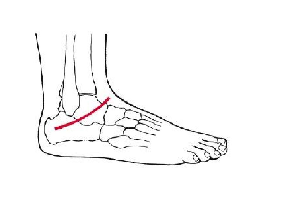 Презентация перелом стопы