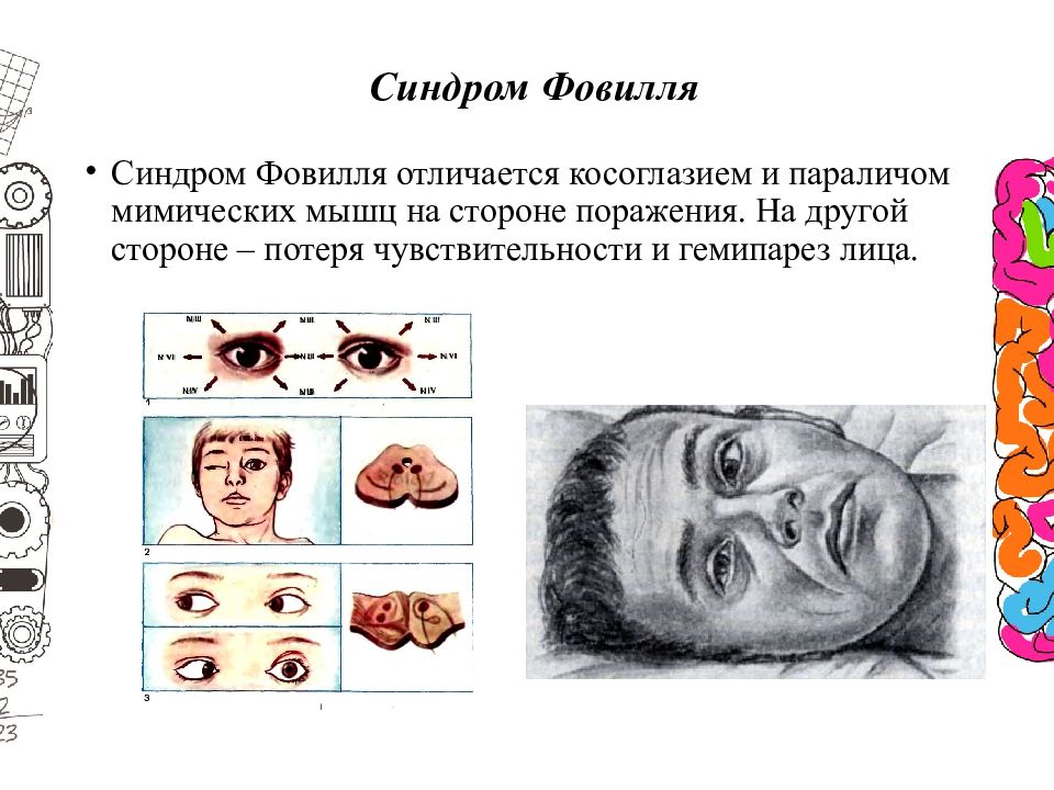 Альтернирующие синдромы схема