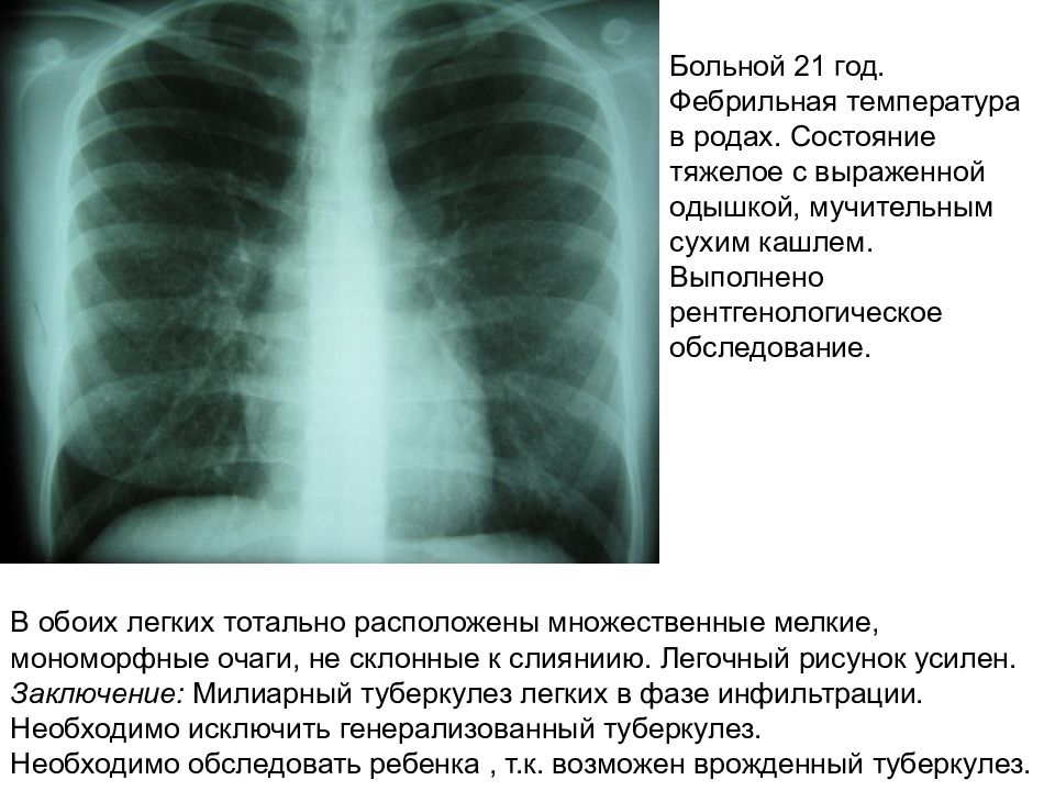 Состояние роде. Мелкоочаговая инфильтрация легких. Что такое фебрильные изменения легких. Одышки при инфильтрации. Фебрильная ткань легких.