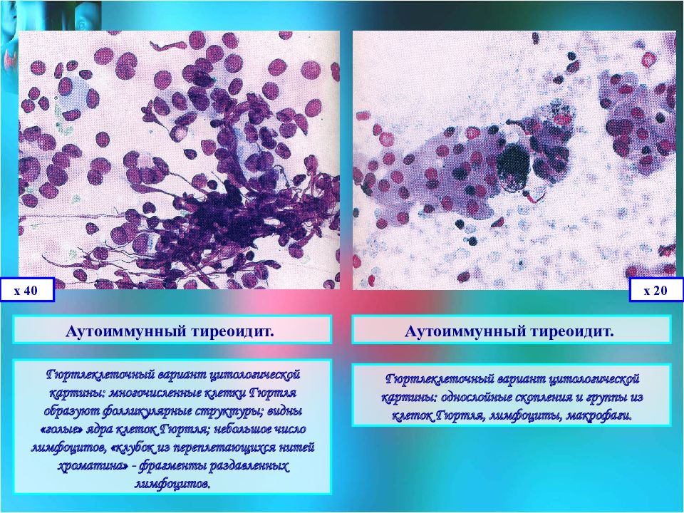 Цитологическая картина тиреоидита хашимото