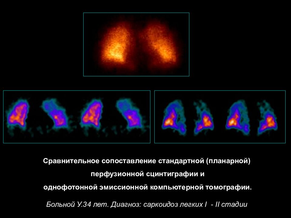 Презентация сцинтиграфия миокарда