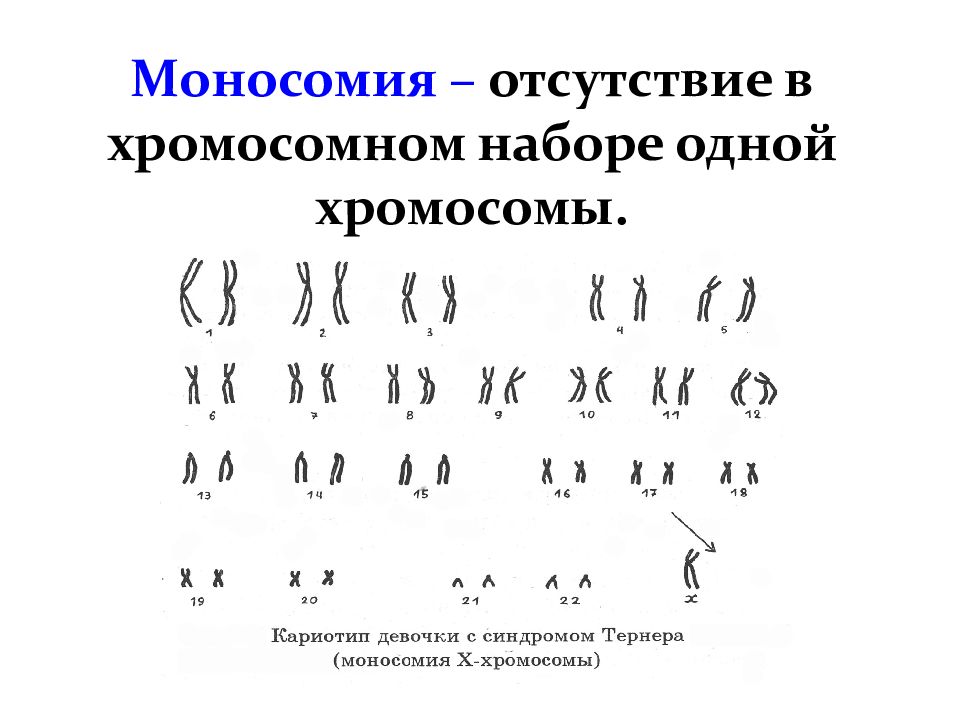Кариотип человека определяют. Кариотип моносомия по х. Набор хромосом при моносомии. Моносомия набор хромосом формула. Кариограмма – моносомия х.