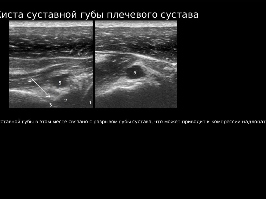 Узи плечевого. УЗИ плечевого сустава норма. УЗИ анатомия плечевого сустава. УЗИ плечевого сустава лекция. Протокол УЗИ плечевого сустава у взрослых.