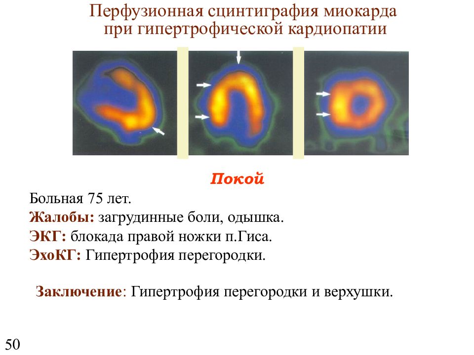 Презентация сцинтиграфия миокарда