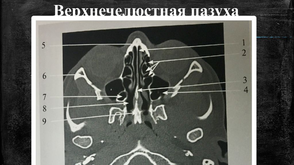 Стенки пазух. Кт анатомия гайморовых пазух. Стенки верхнечелюстной пазухи анатомия кт. Кт анатомия верхнечелюстной пазухи. Стенки гайморовой пазухи анатомия на кт.