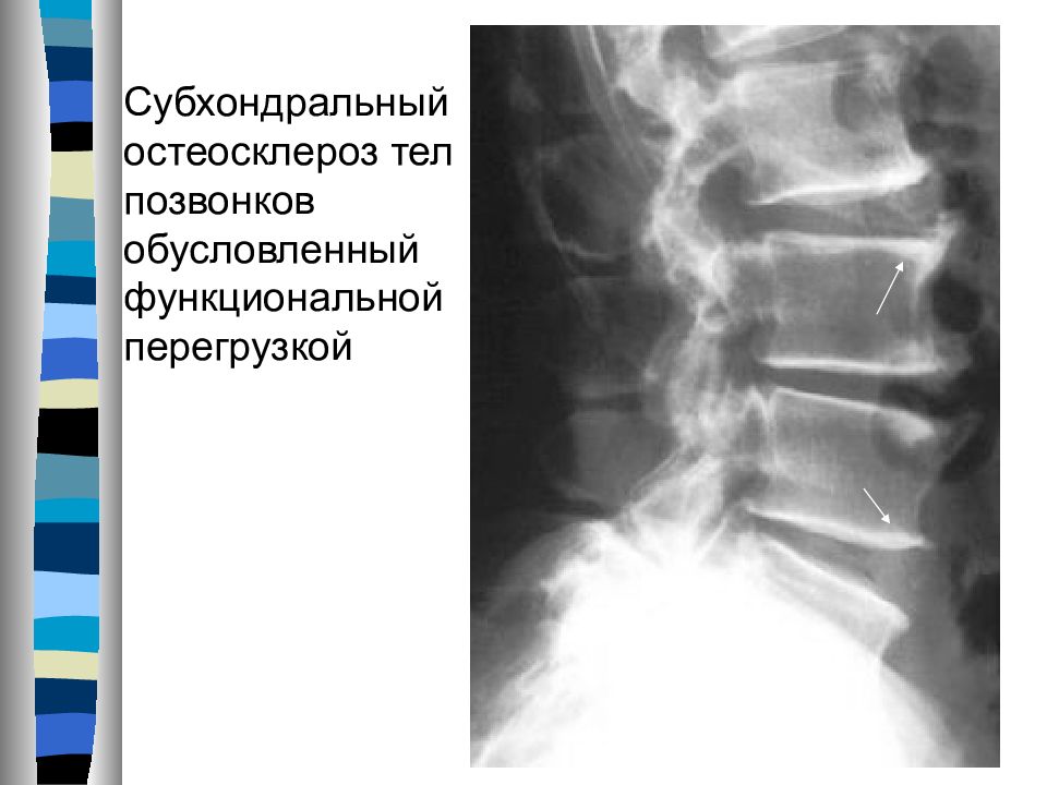 Склероз замыкательных пластинок позвоночника. Остеосклероз позвоночника рентген. Замыкательные пластинки тел позвонков на рентген. Остеосклероз тел позвонков кт. Остеосклеротический очаг 6 ребра.