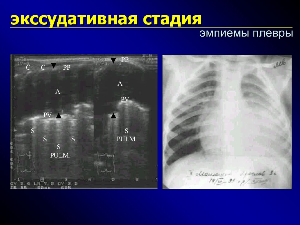 Бактериальная деструкция легких у детей презентация