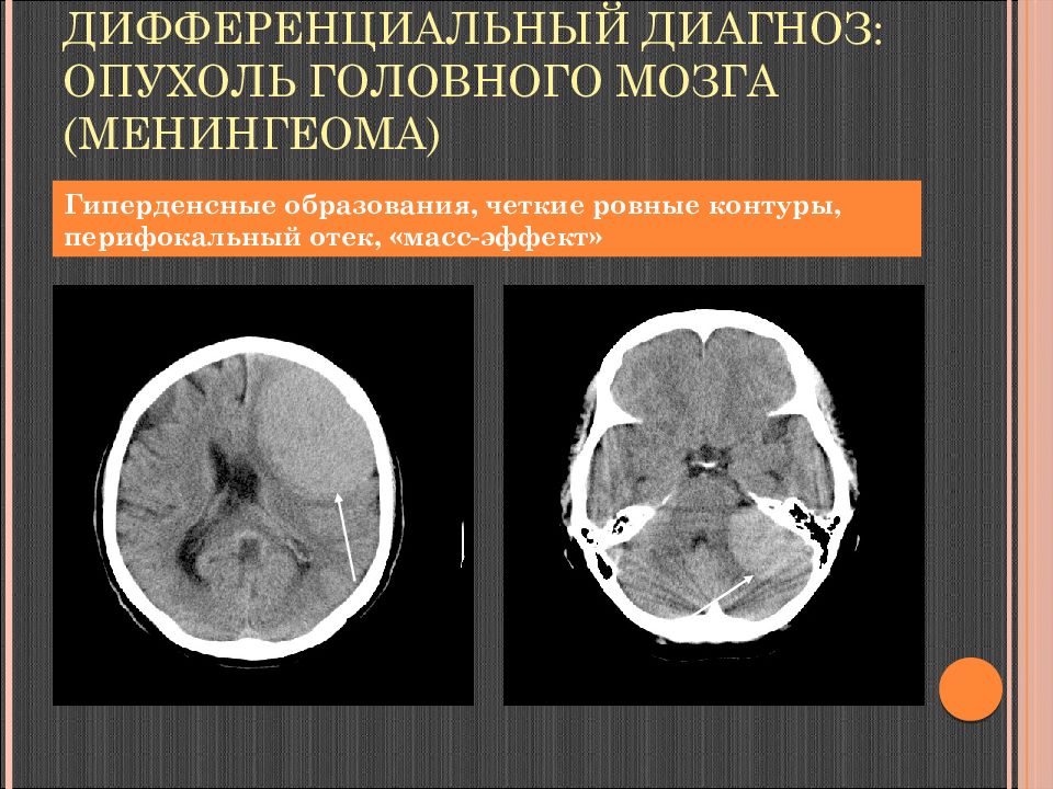 Диагноз опухоли мозга. Опухоль головного мозга кт с отеком. Перифокальный отек головного мозга на кт. ОТК головного мозга накт. Объемное образование головного мозга кт.