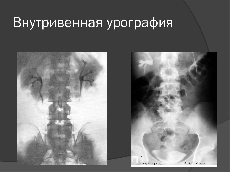 Внутривенная урография презентация