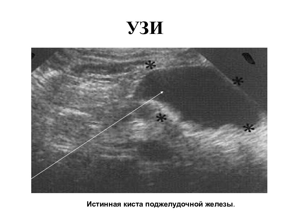 Кисты желез. Киста поджелудочной железы на УЗИ. Истинные кисты поджелудочной. Истинная киста поджелудочной железы. Истинные и ложные кисты поджелудочной железы.