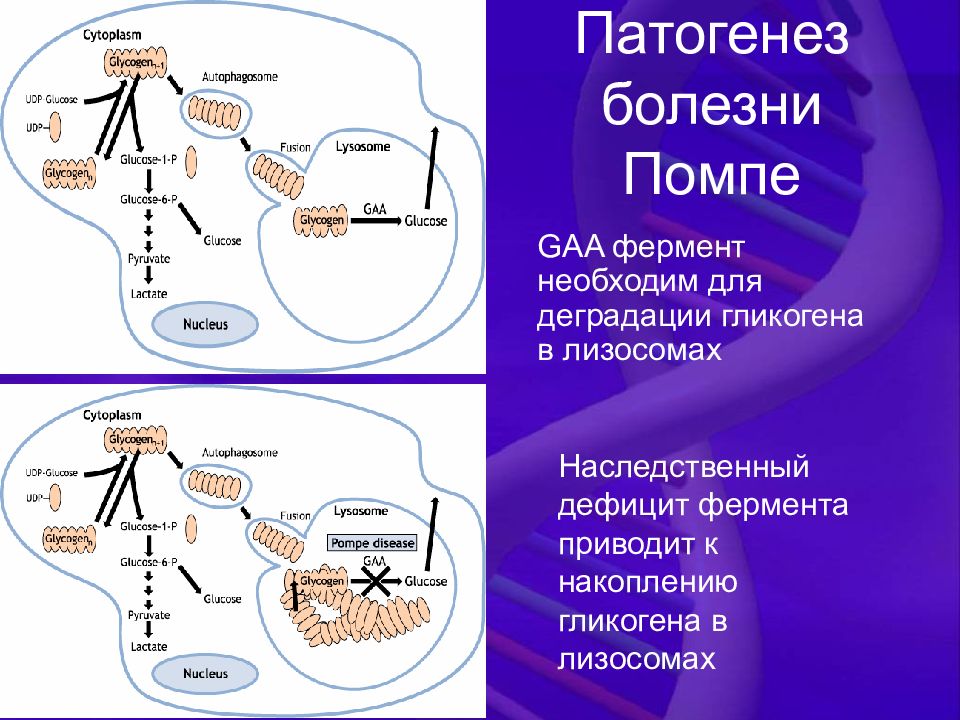 Патогенез болезни. Болезнь помпе патогенез. Лизосомные болезни накопления патогенез. Болезнь помпе биохимия.