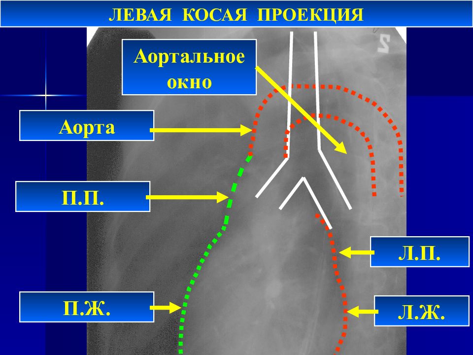 Косая проекция. Аортальное окно. Аорто пульмональное окно. Левая косая проекция. Лимфоузлы аортального окна.