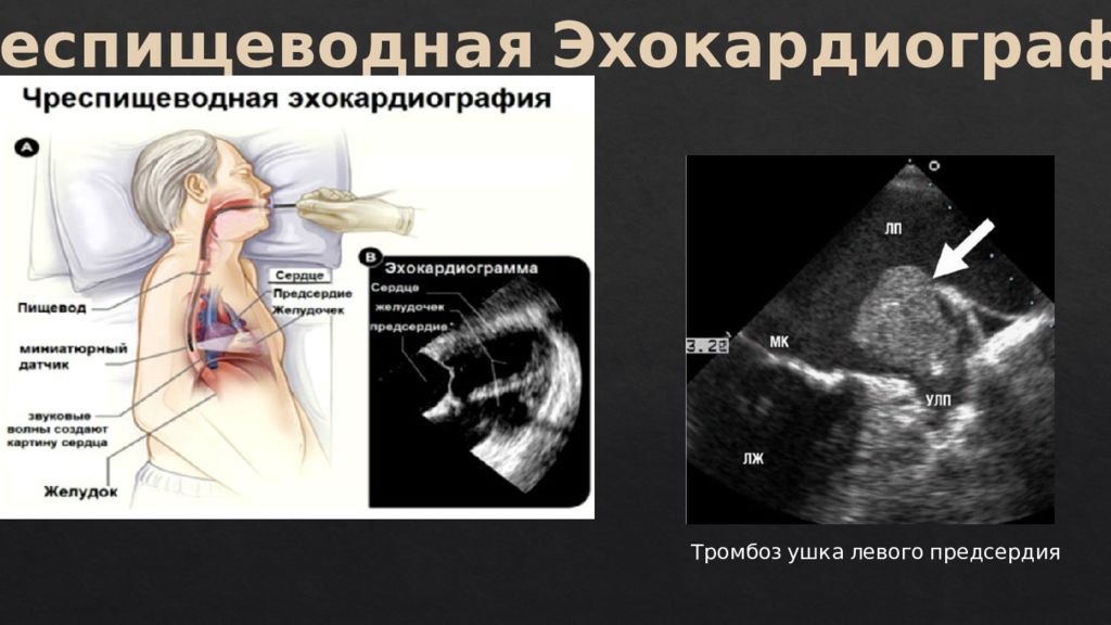 Эх кг. Трансэзофагеальная эхокардиография. Эхокардиография через пищевод. Трансторакальная чреспищеводная ЭХОКГ. Чреспищеводное УЗИ сердца.