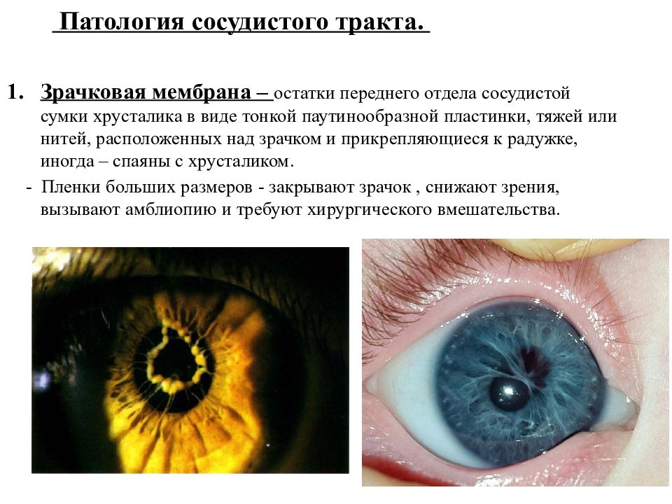 Наследственные заболевания зрения. Врожденная аномалия зрачка. Наследственные заболевания органа зрения. Патология сосудистого тракта глаза. Врожденные патологии органов зрения.