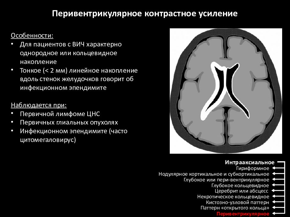 Лейкомаляция головного мозга