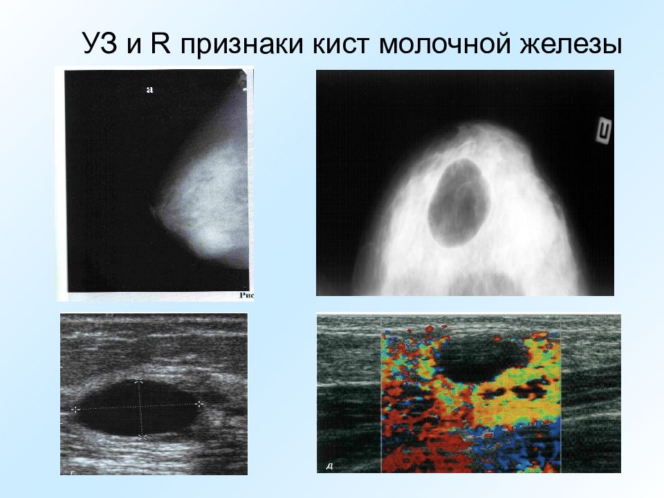 Кисты молочных желез могут рассосаться