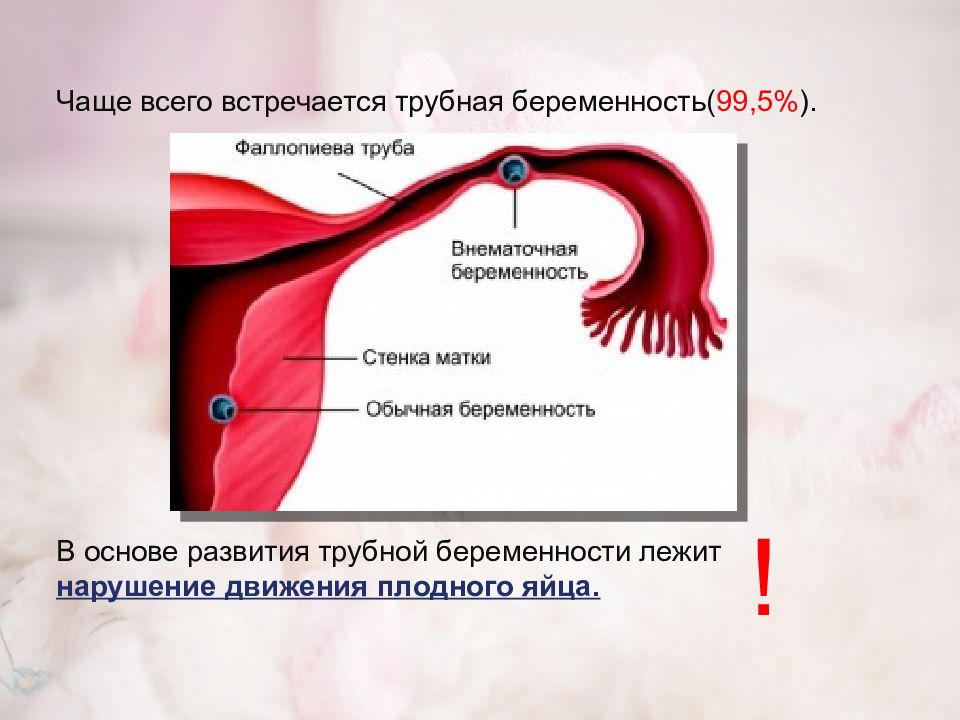 Внематочная беременность картинки