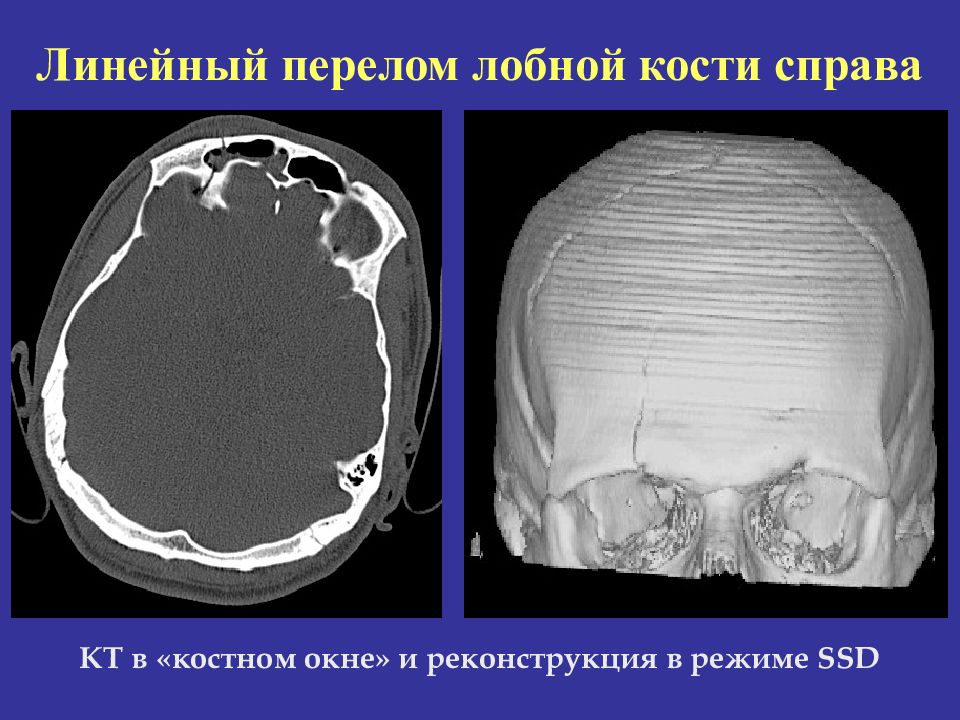 Вдавленный перелом лобной кости. Линейный перелом черепа у ребенка.