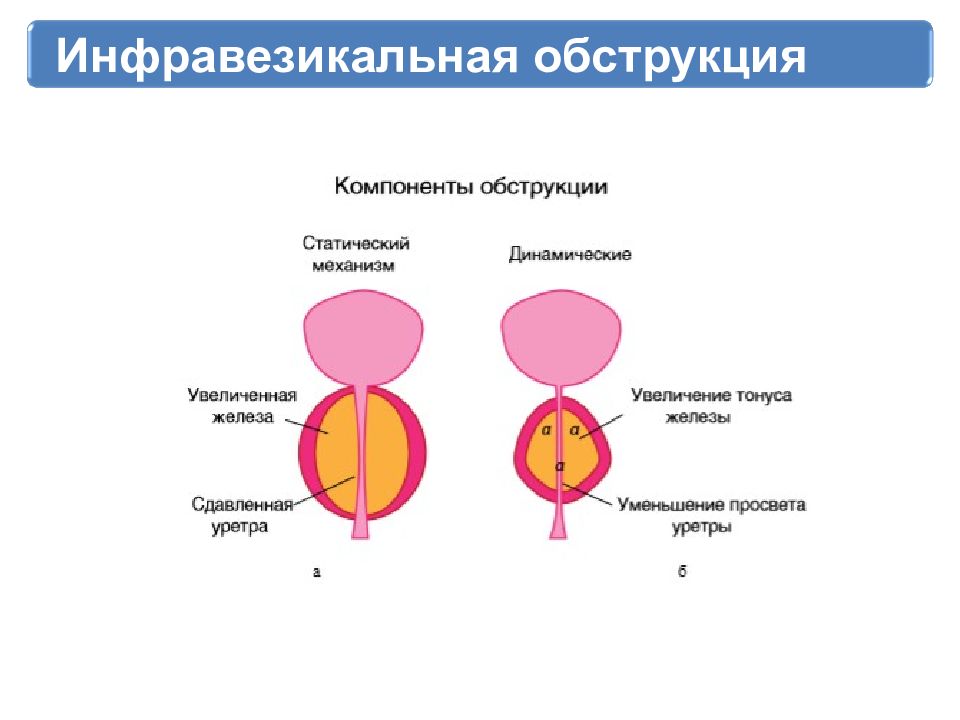 Аденома простаты симптомы. Инфравезикальная обструкция мочевого. ДГПЖ предстательной железы что это такое. Доброкачественная гиперплазия предстательной железы формы. Аденома предстательной железы и ДГПЖ.