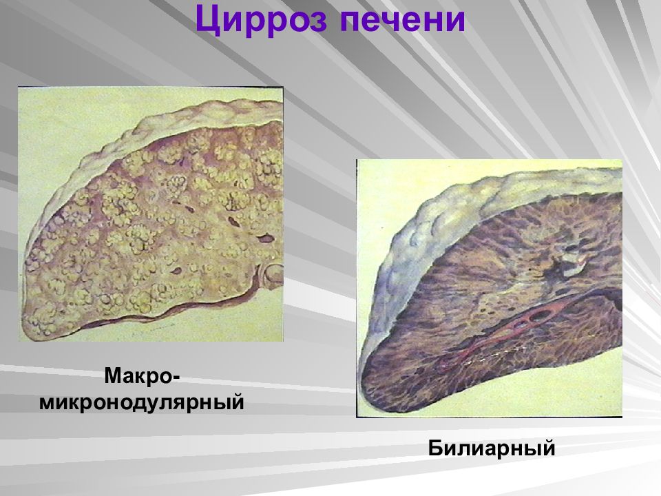 Билиарный цирроз печени презентация