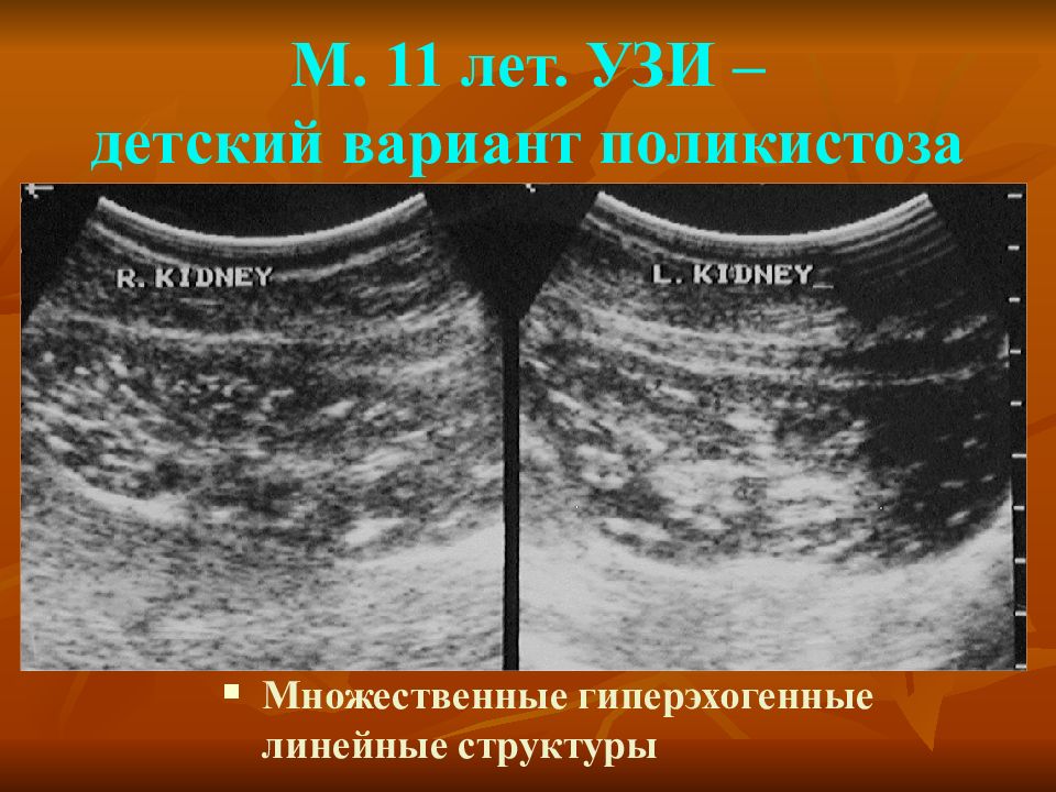 Поликистоз почек на узи. УЗИ критерий поликистоза почек. Гиперэхогенные линейные структуры. Поликистоз почек на УЗИ У детей.