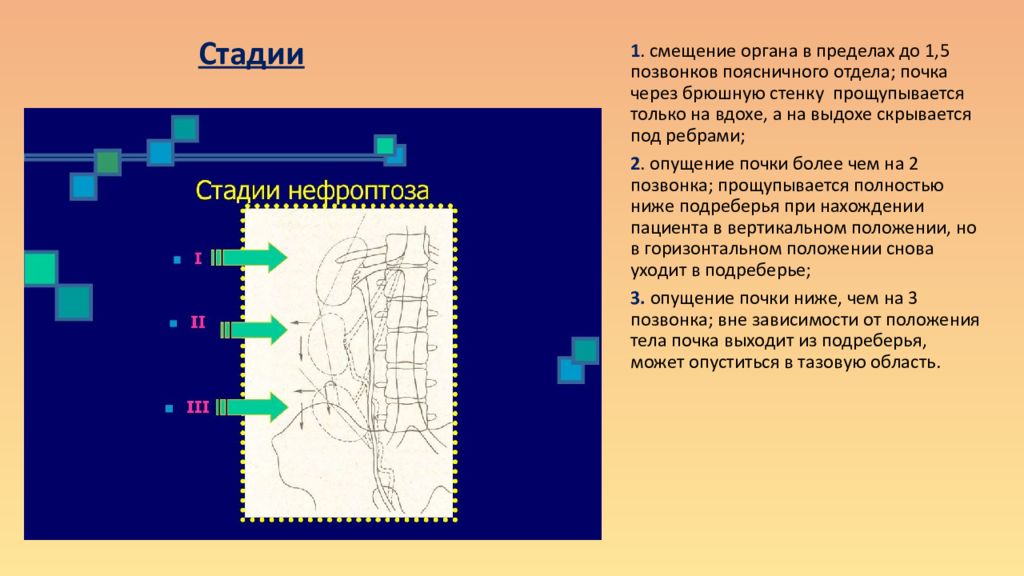 Степени нефроптоза. Стадии нефроптоза. Выявление нефроптоза. Презентация на тему нефроптоз.