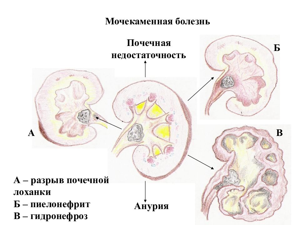 Гидронефроз клиническая картина