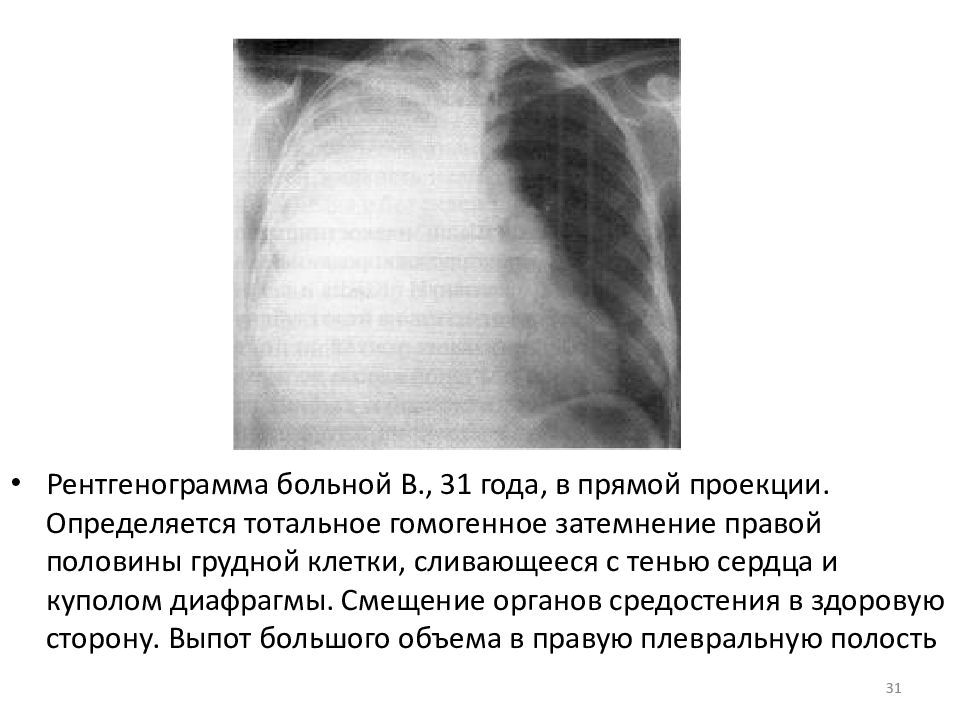 Объясните почему на рентгеновском снимке изображение газа в плевральной полости черное