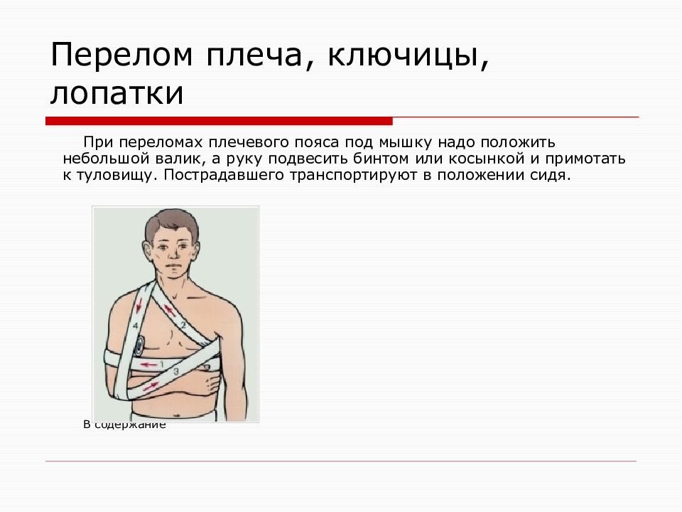 Оказание первой помощи при переломе ключицы. При переломе плеча активные движения в суставе. Транспортировкапри переломе клюяицы. При переломе плеча необходимо. При переломе ключицы необходимо:.