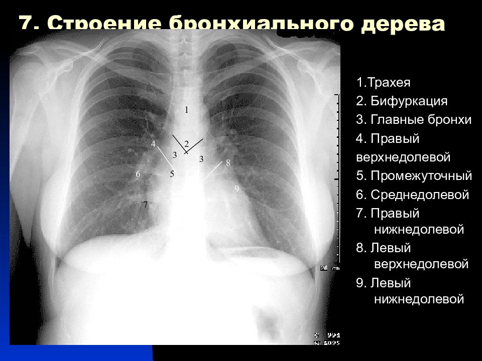 На каком уровне бифуркация трахеи