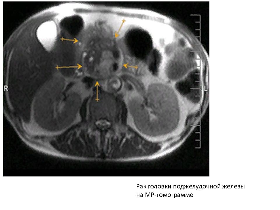 Рак головки. Лимфома поджелудочной железы кт. Аденокарцинома поджелудочной железы кт. Лимфома брюшной полости на кт. Опухоль поджелудочной железы мрт.