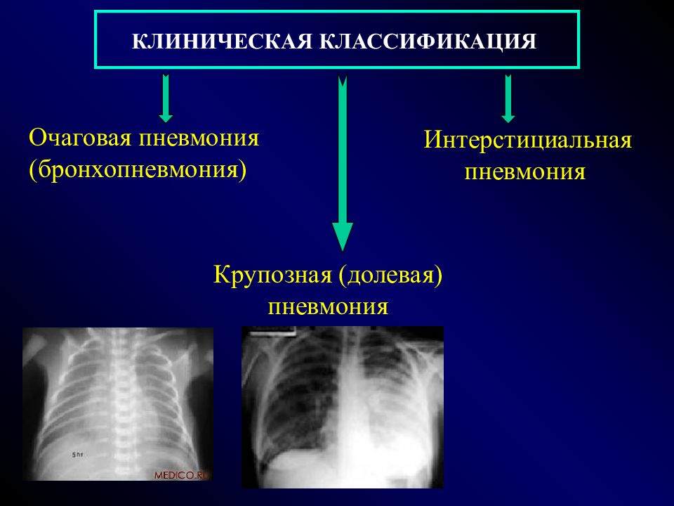 Пневмония очаговая презентация