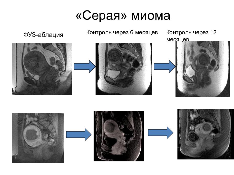 Миома матки мрт картина