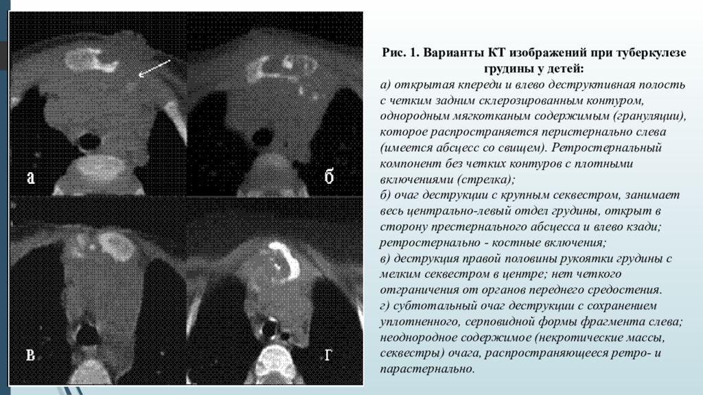 Очаги в плевре. Деструкция при туберкулезе. Специфическое воспаление при туберкулезе. Воспалительная деструкция туберкулеза.