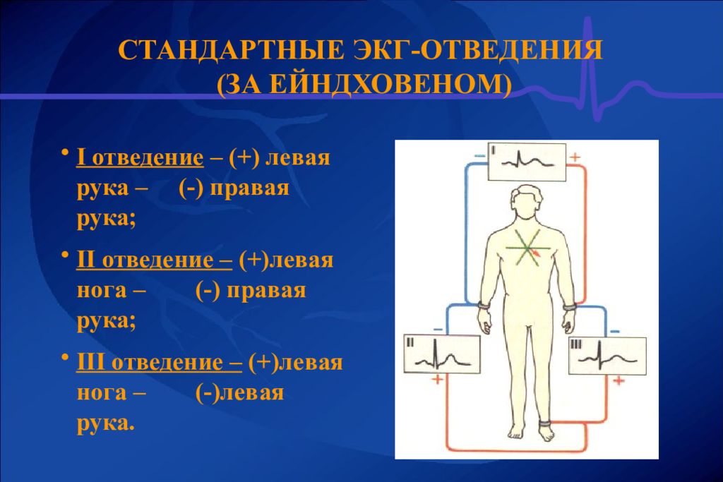 Правые отведения. Отведения ЭКГ. Стандартные отведения ЭКГ. Электрокардиографические отведения. Станд=артные отведения ЭКГ.