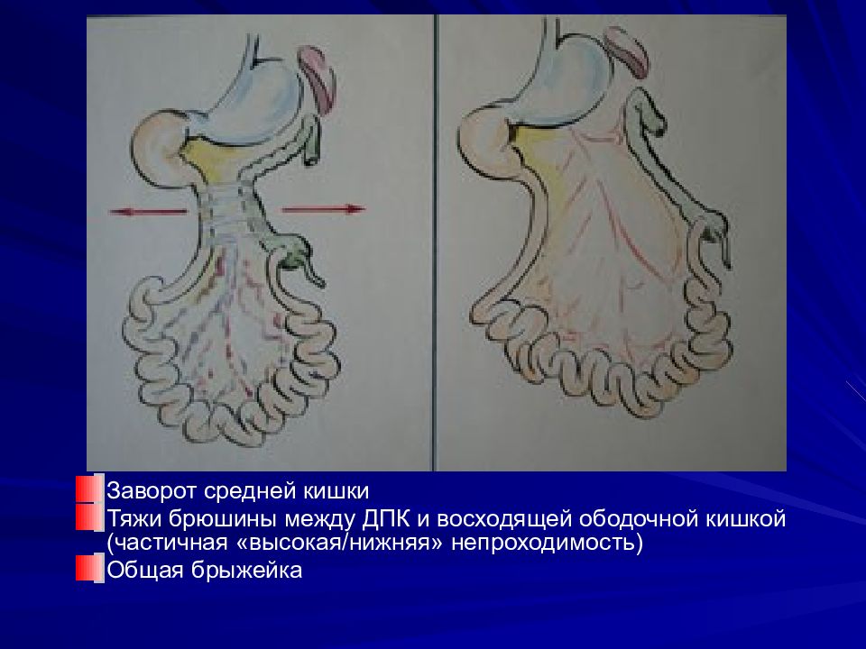 Кишечная непроходимость патофизиология презентация