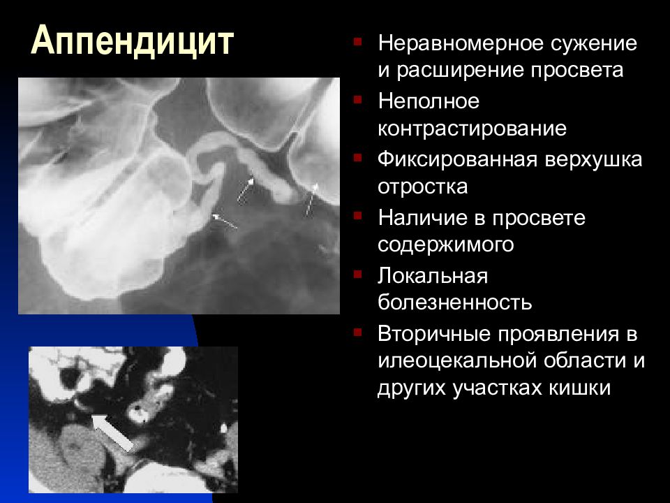 расширение просвета бронхов. диагноз дуоденостаз что это. расширение кардиального отдела пищевода. расширение просвета. расширение просвета.