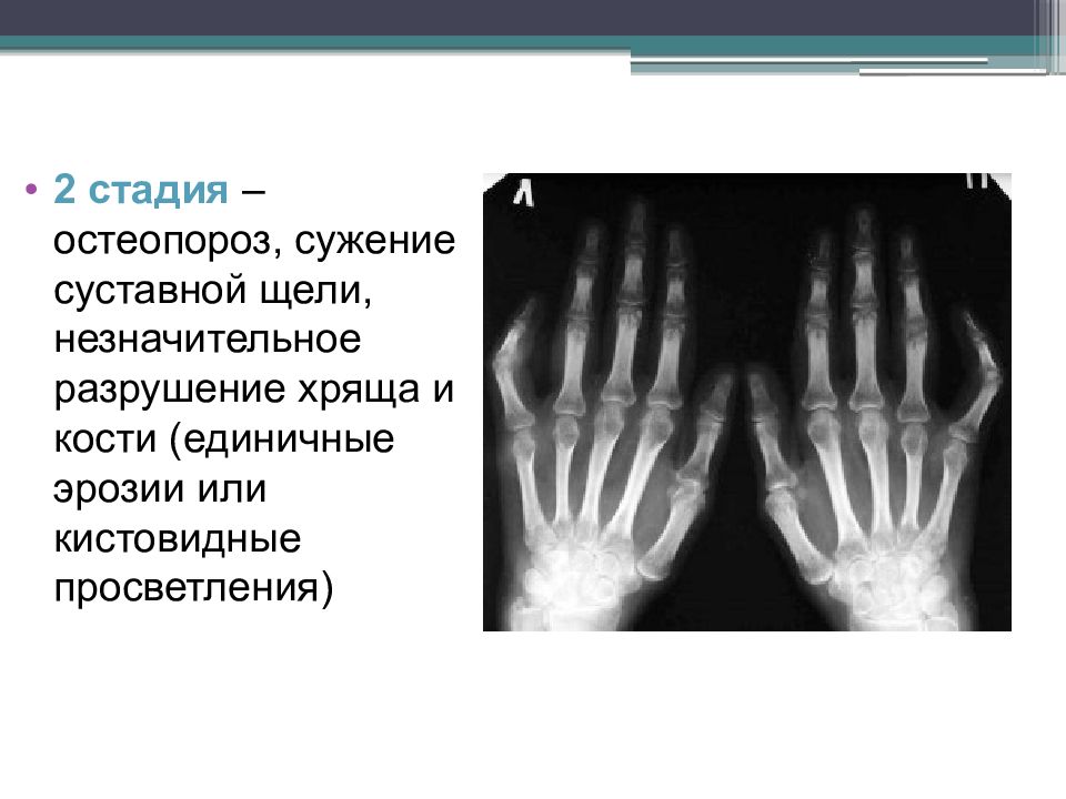 Единичное кистовидное просветление. Ревматоидный артрит степени рентген. Ревматоидный артрит кистовидные просветления. Остеопороз костей кисти на рентгене. Ревматоидный артрит 2 рентгенологическая стадия.