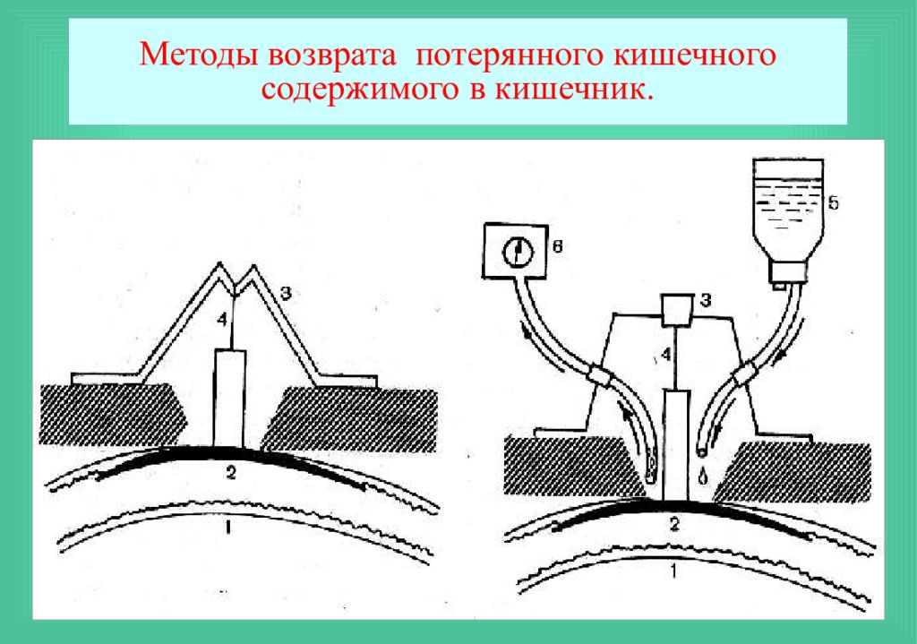 Возвращающие методы. Метод исследования свищей. Метод Возвращение потерь. Управляемый и неуправляемый свищ. Обработка кишечных свищей с выделением содержимого алгоритм.