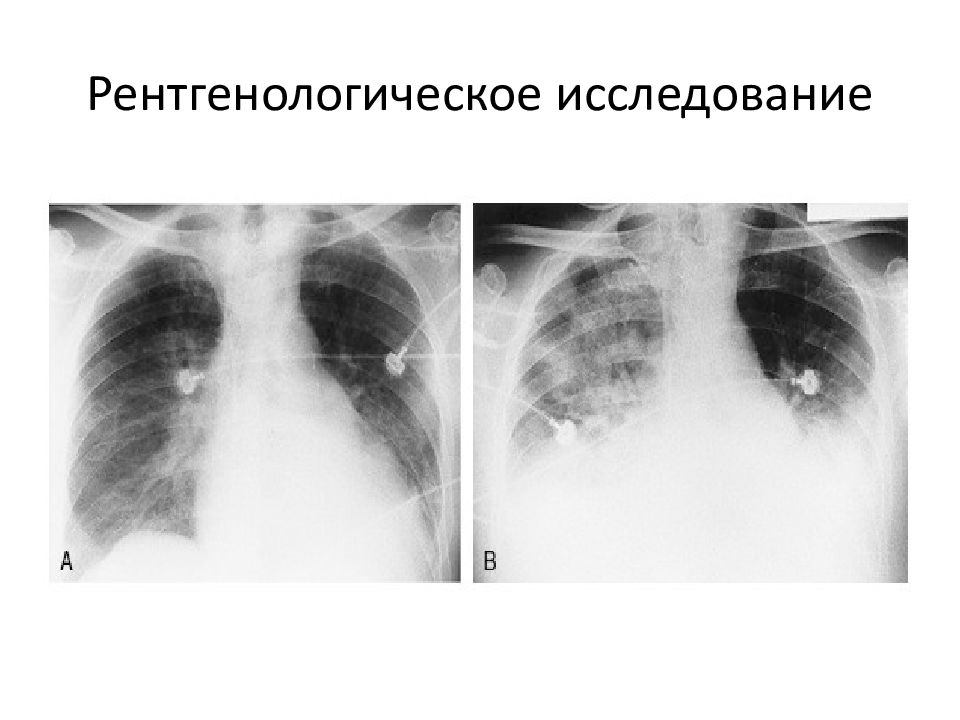 Митральные пороки