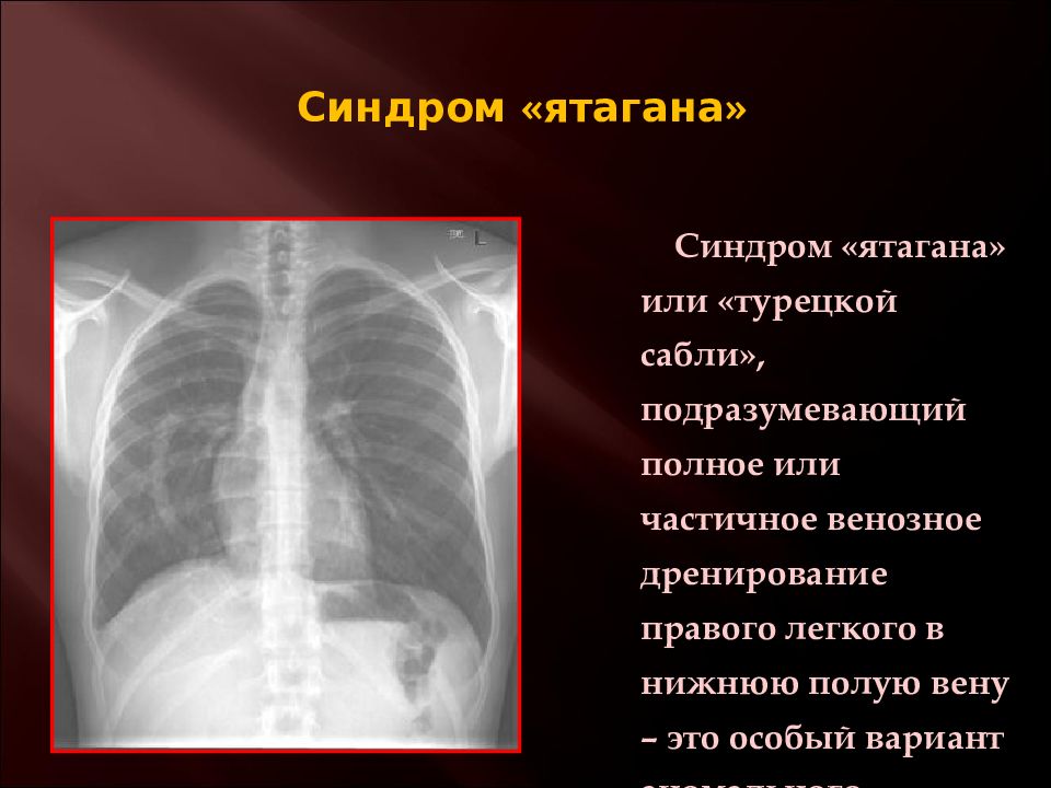 Венозный дренаж. Синдром ятагана рентген. Симптом турецкой сабли на рентгенограмме. Синдром ятагана рентген легких.