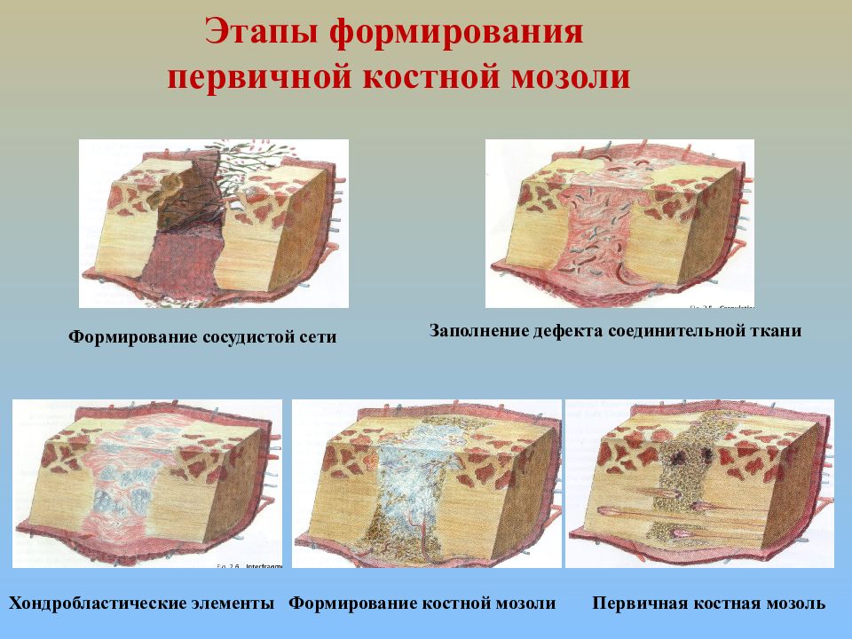 Первичное формирование. Стадии заживления костной ткани. Этапы заживления костной ткани. Этапы формирования костной мозоли. Формирование костной Манхони.