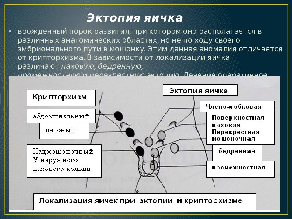 Презентация аномалии яичек