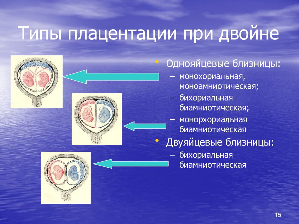 Однояйцевые близнецы. Двуяйцевые близнецы.