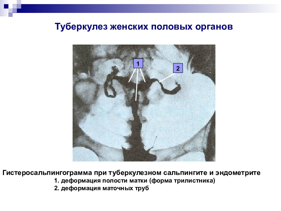 Туберкулез половых органов у женщин. Туберкулез половых органов. Туберкулез маточных труб. Туберкулез женских органов. Туберкулез женских половых органов презентация.