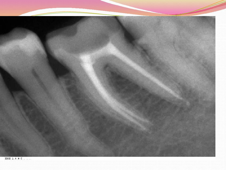 Рентгенография в эндодонтии презентация