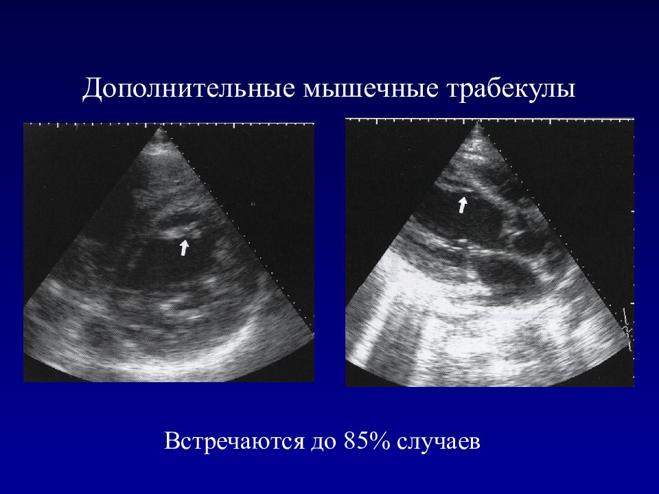 Дополнительная левого желудочка. Дополнительная трабекула левого желудочка на УЗИ. Дополнительная трабекула левого желудочка сердца. Дополнительные трабекулы в левом желудочке. Диагональная трабекула левого желудочка.